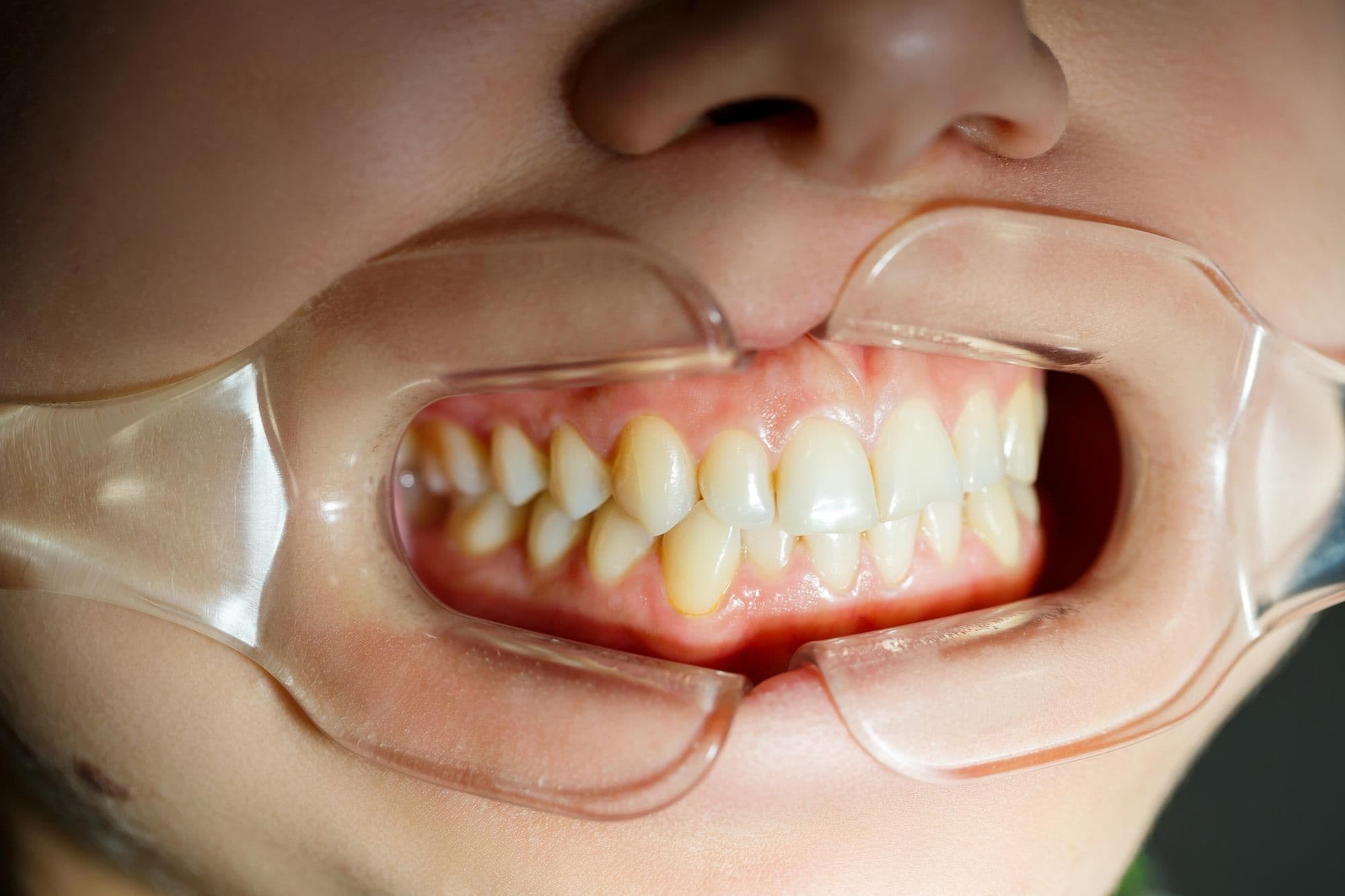 Избавление от кариеса в домашних условиях: можно ли его остановить и как? Избавление от кариеса в домашних условиях: можно ли его остановить и как?